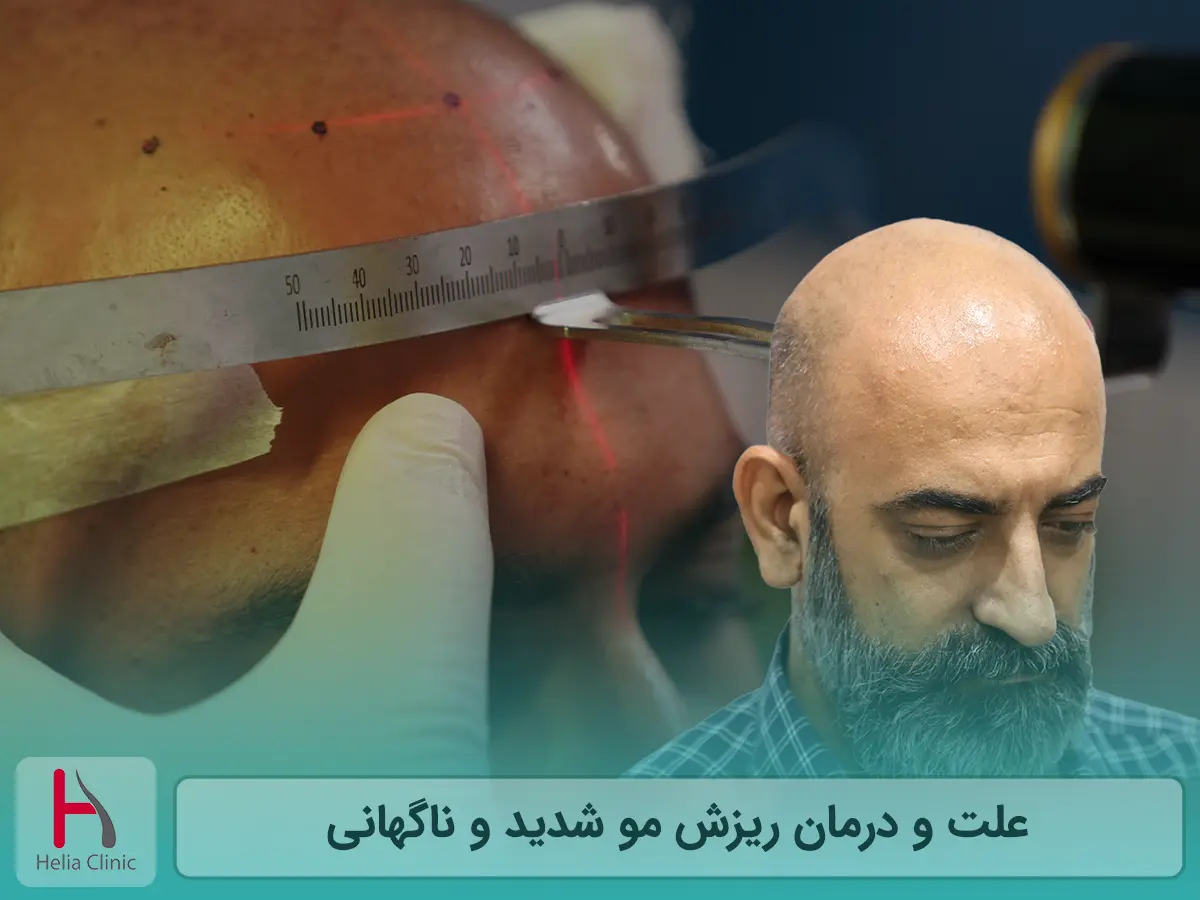علت و درمان ریزش مو شدید و ناگهانی