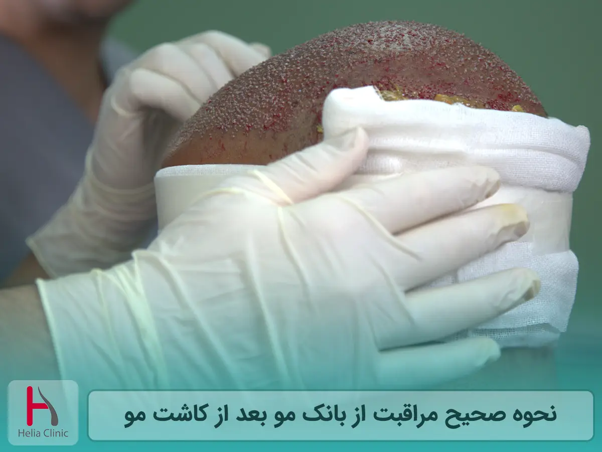 ترمیم بانک مو بعد از کاشت مو: نحوه صحیح مراقبت
