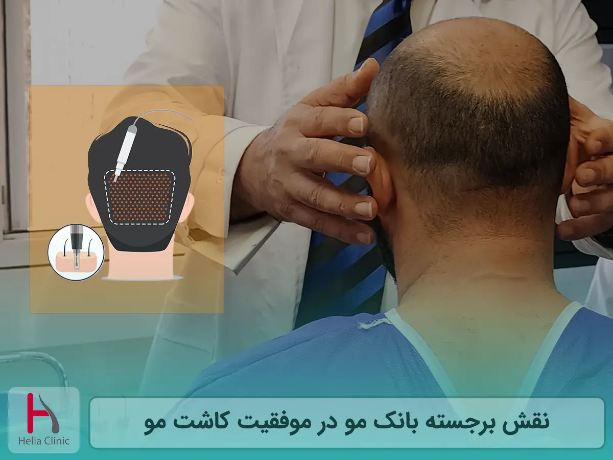 اهمیت بانک مو برای کاشت موی موفقیت آمیز