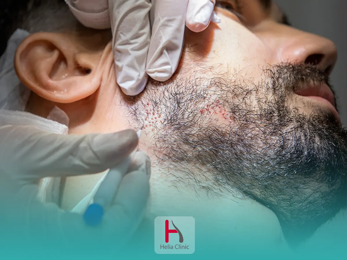 کاشت ریش طبیعی در کلینیک هلیا