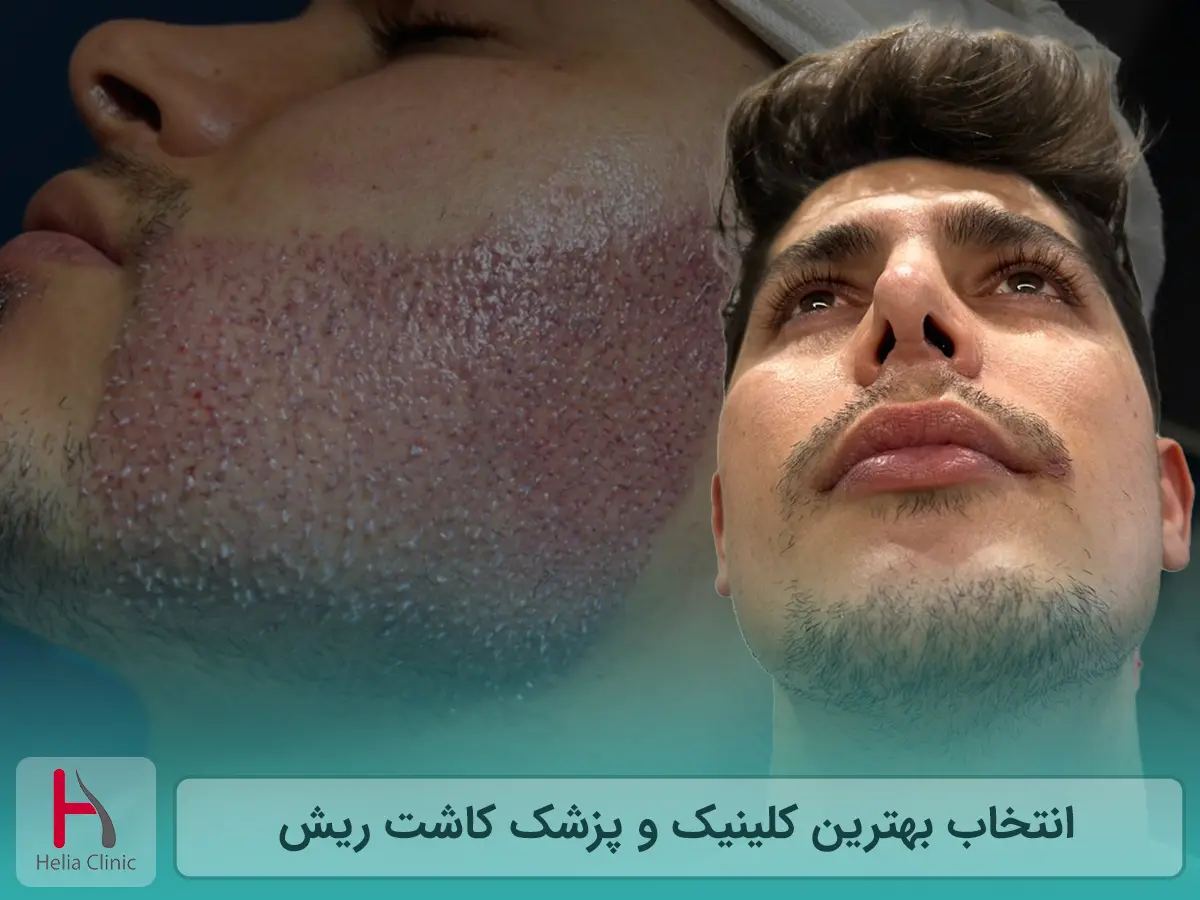 انتخاب بهترین کلینیک و پزشک کاشت ریش