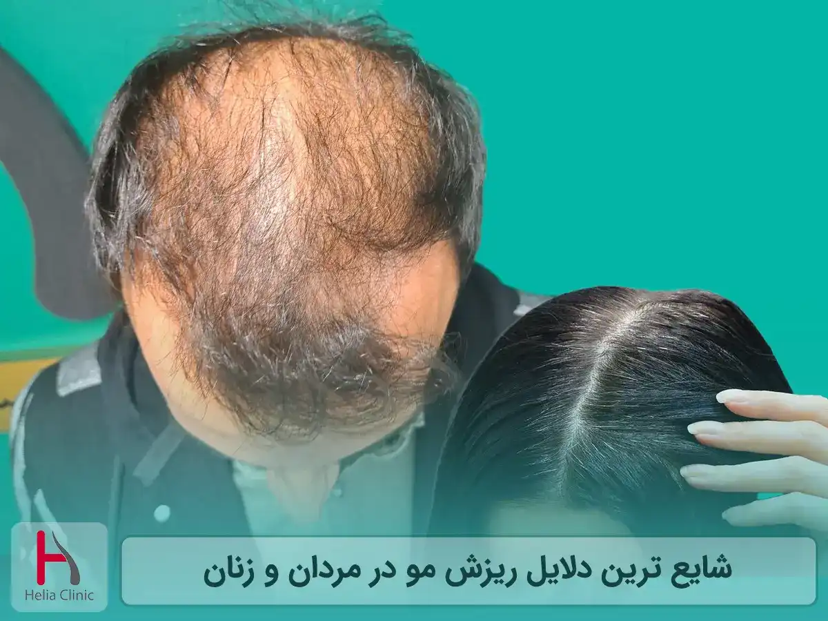دلایل ریزش مو در مردان و زنان