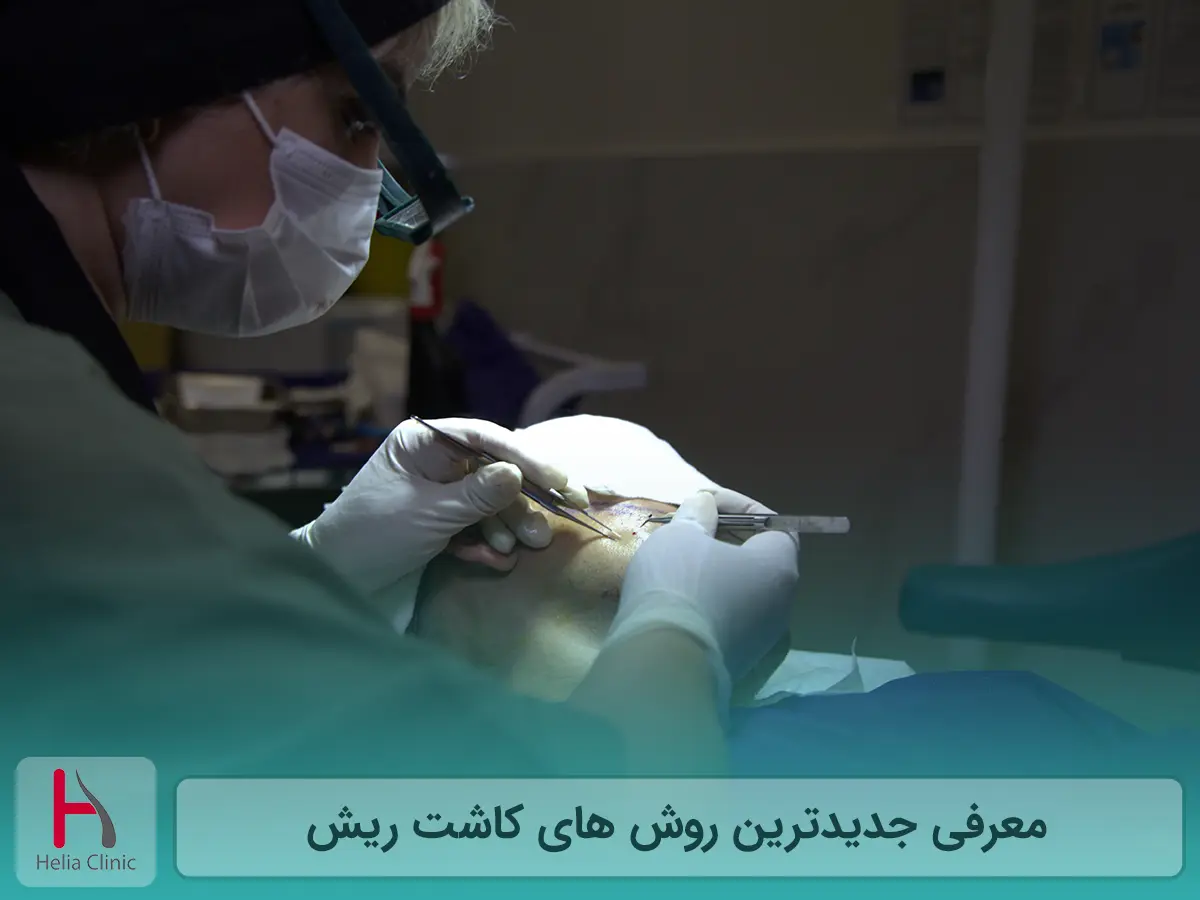 معرفی جدیدترین روش های کاشت ریش