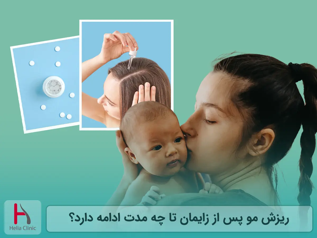 ریزش مو پس از زایمان تا چه مدت ادامه دارد؟