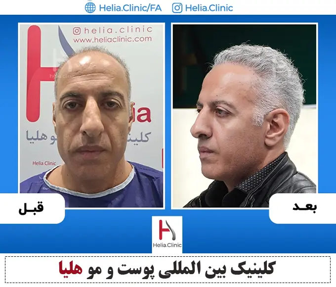 عکس قبل و بعد کاشت مو روش دی اچ آی