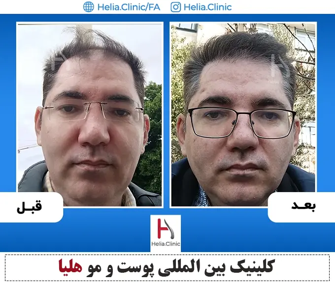 نمونه کار قبل و بعد پیوند مو sut