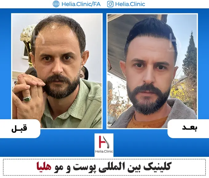 عکس قبل و بعد پیوند مو اف آی تی