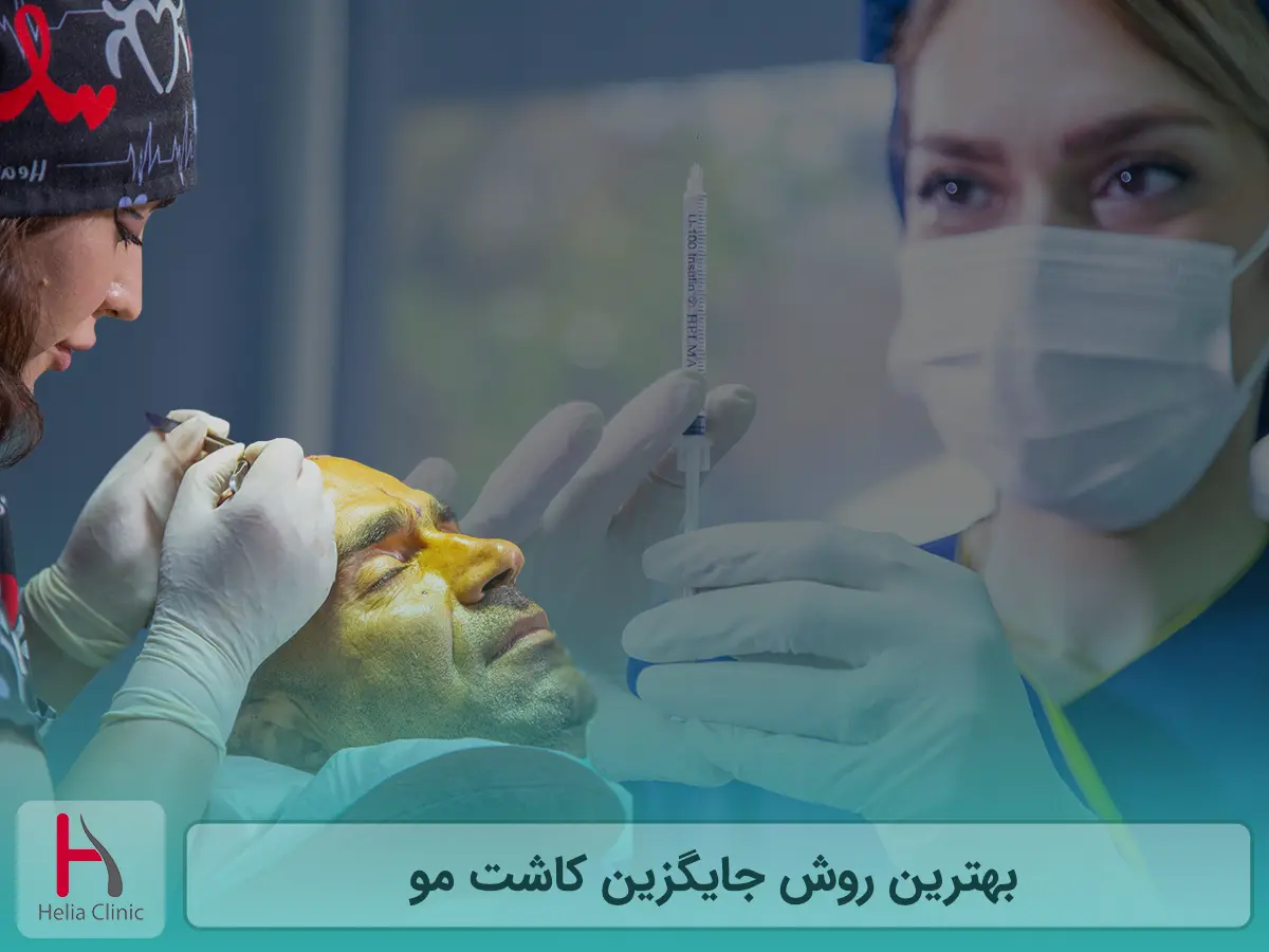 بهترین روش جایگزین کاشت مو
