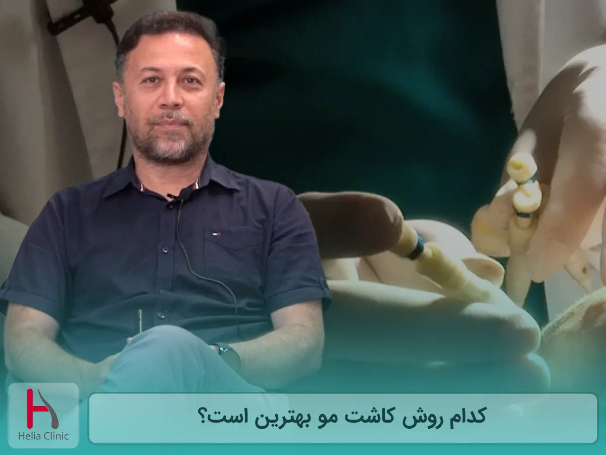 کدام روش کاشت مو بهترین است؟