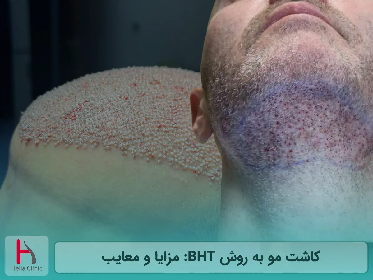 کاشت مو به روش BHT: مزایا و معایب