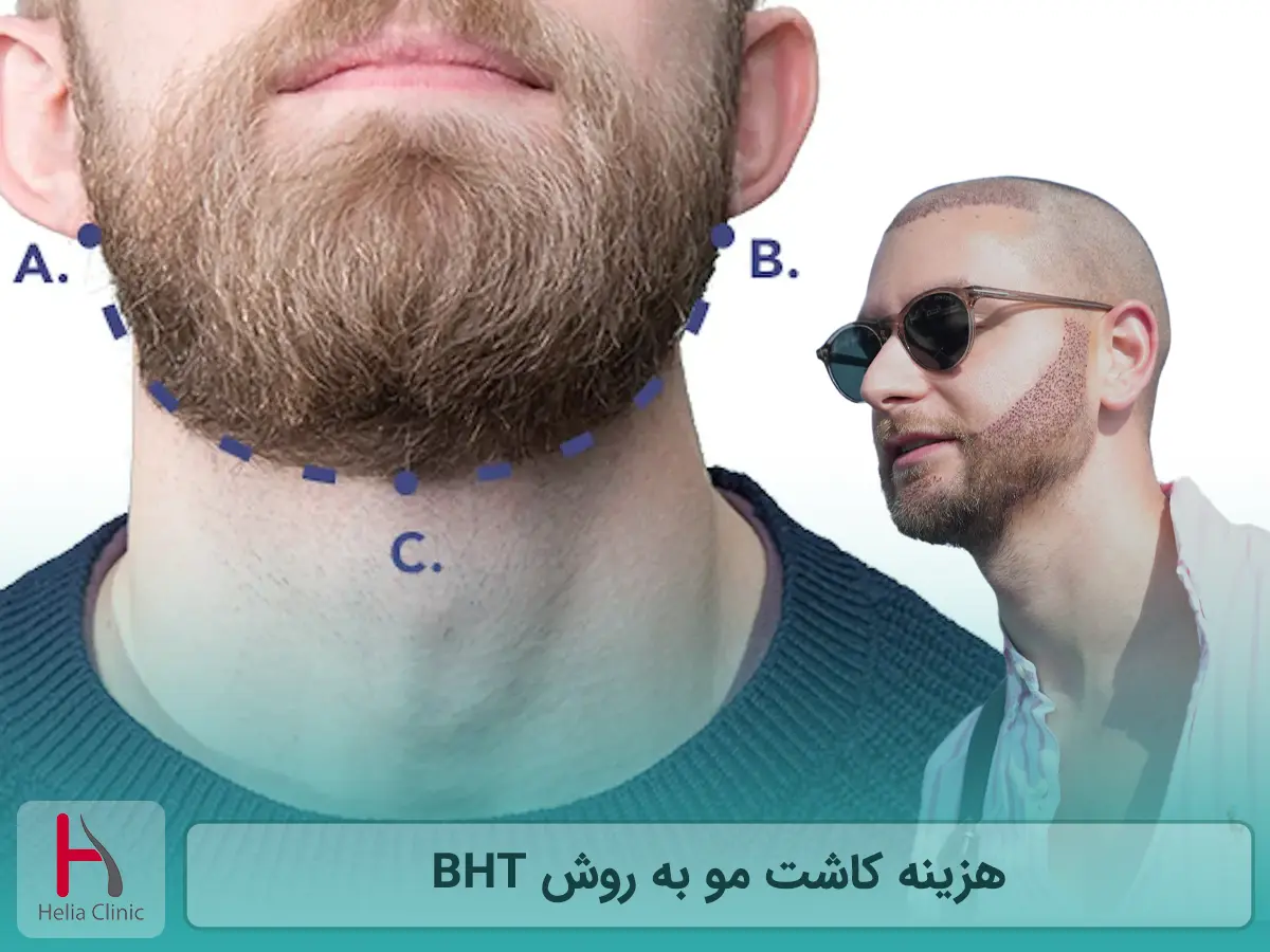 هزینه کاشت مو به روش BHT