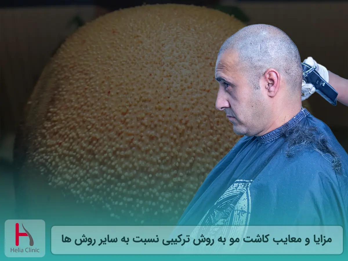 مزایا و معایب کاشت مو به روش ترکیبی نسبت به سایر روش ها