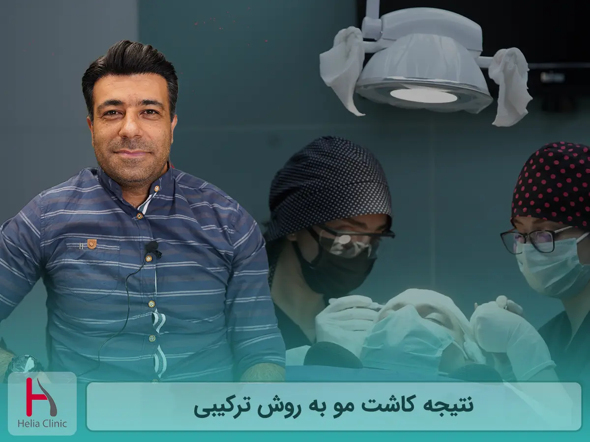 نتیجه کاشت مو به روش ترکیبی