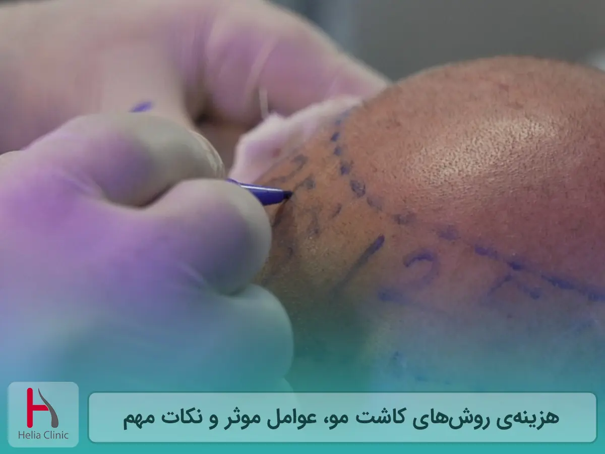 قیمت انواع روش کاشت مو در کلینیک هلیا