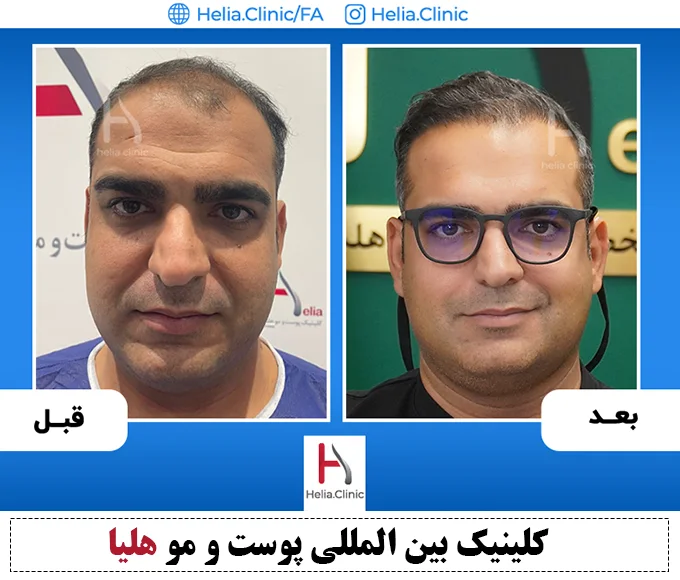 مقایسه انواع متدهای کاشت موی طبیعی