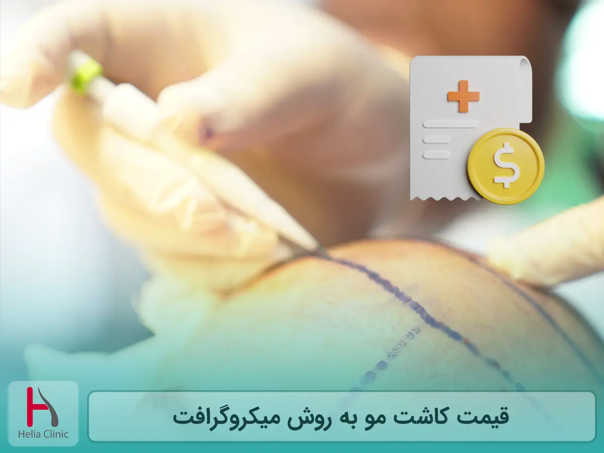 قیمت کاشت مو به روش میکروگرافت