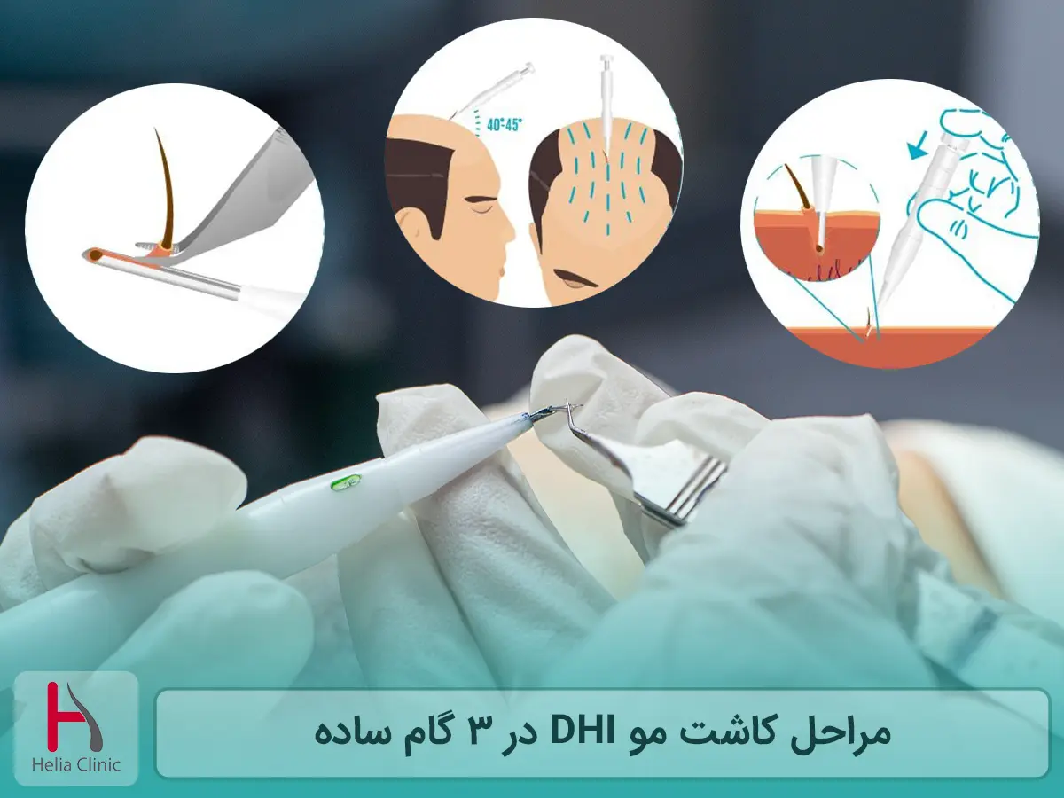 مراحل کاشت مو DHI در 3 گام ساده