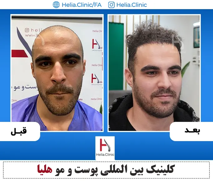 پیوند موی طبیعی به روش دی اچ آی توسط دکتر خراسانی