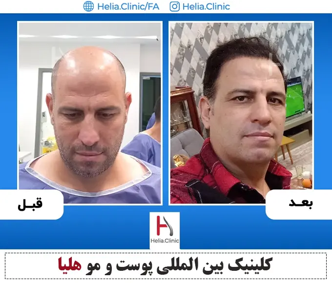 نمونه تصویر پیوند مو dhi