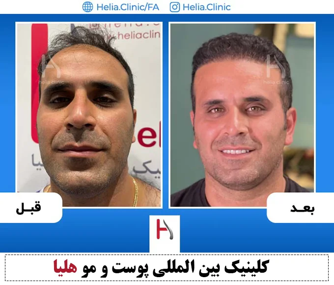 متدهای مختلف پیوند موی طبیعی