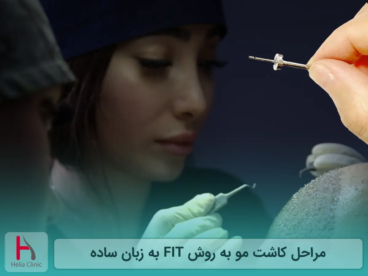 مراحل کاشت مو به روش FIT به زبان ساده