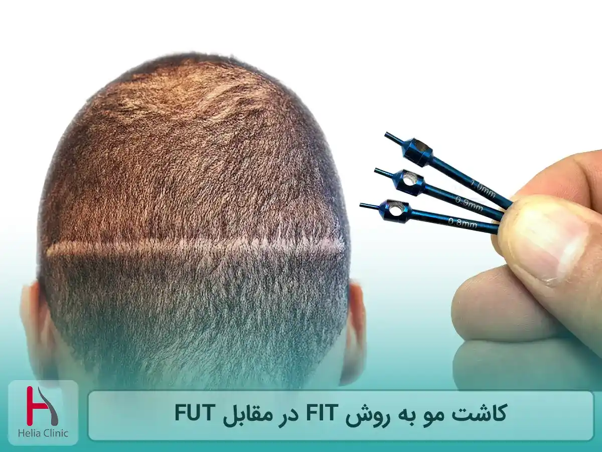 کاشت مو به روش FIT در مقابل FUT