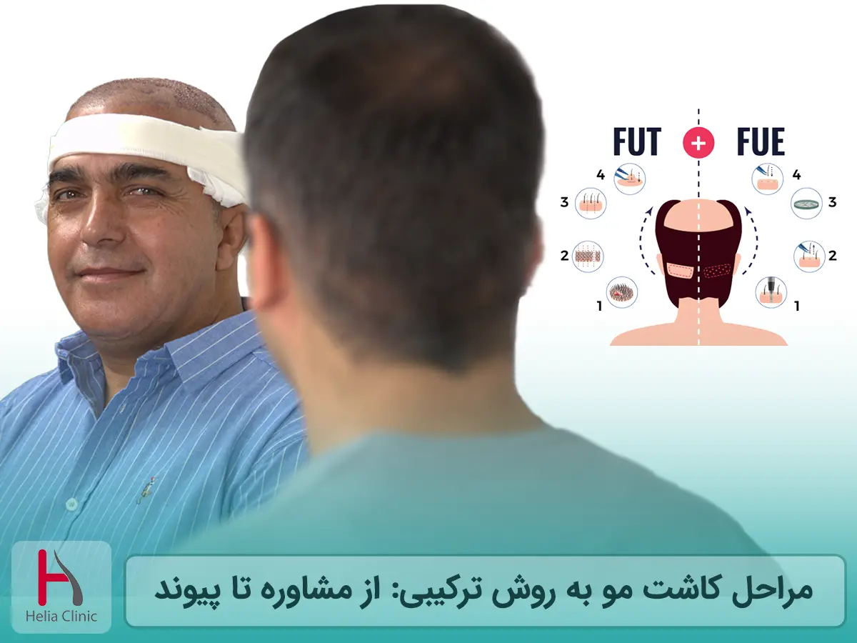 مراحل کاشت مو به روش ترکیبی: از مشاوره تا پیوند