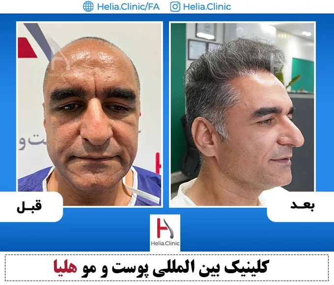 راهنمای انتخاب شیوه های مختلف کاشت مو