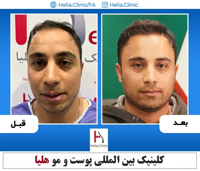 کاشت مو به روش میکروگرافت هلیا