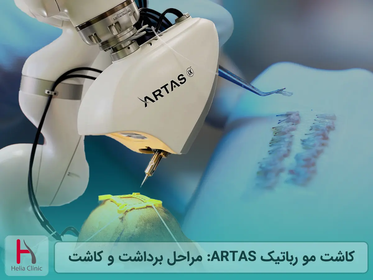 کاشت مو رباتیک ARTAS: مراحل برداشت و کاشت