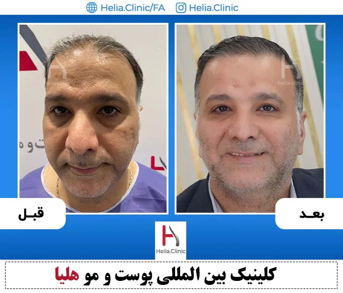 تصویر کاشت مو به شیوه اف آی تی