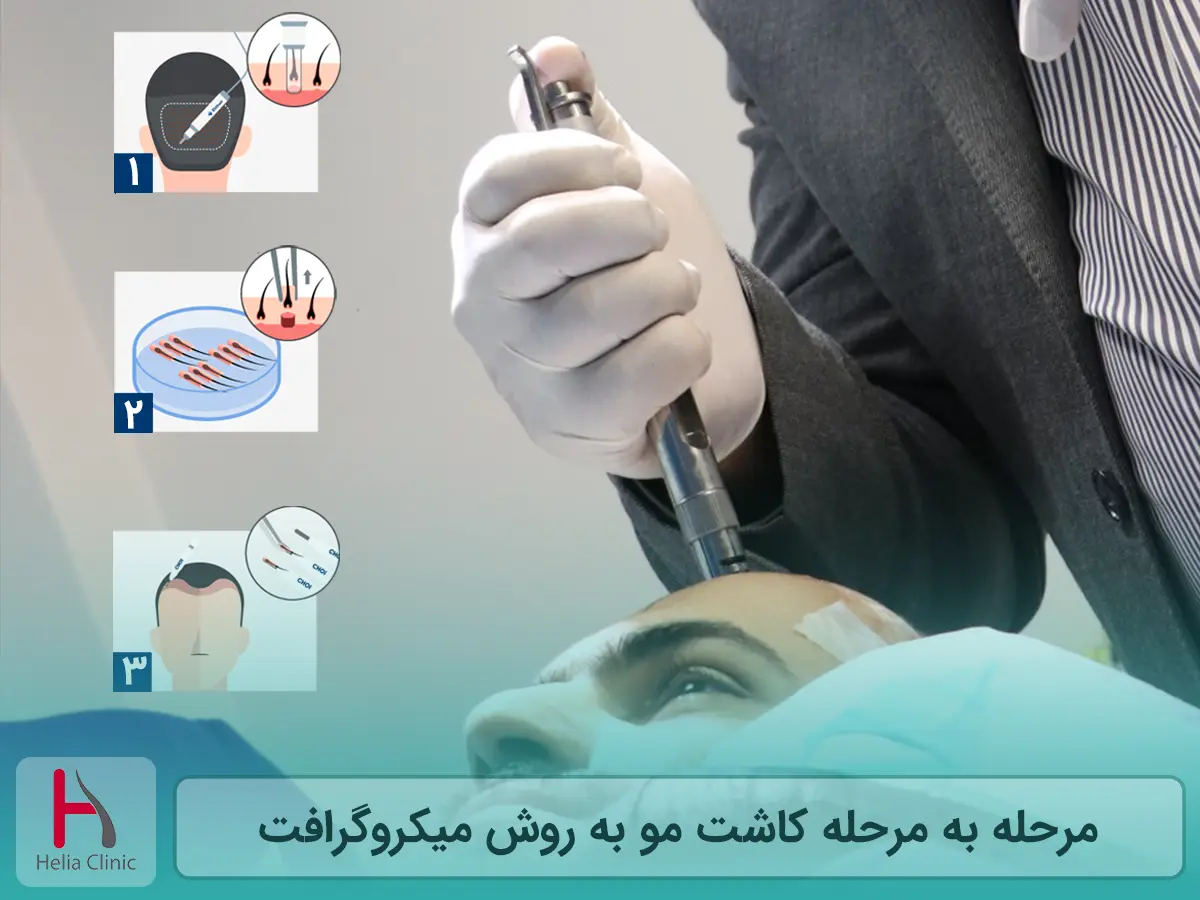مرحله به مرحله کاشت مو به روش میکروگرافت
