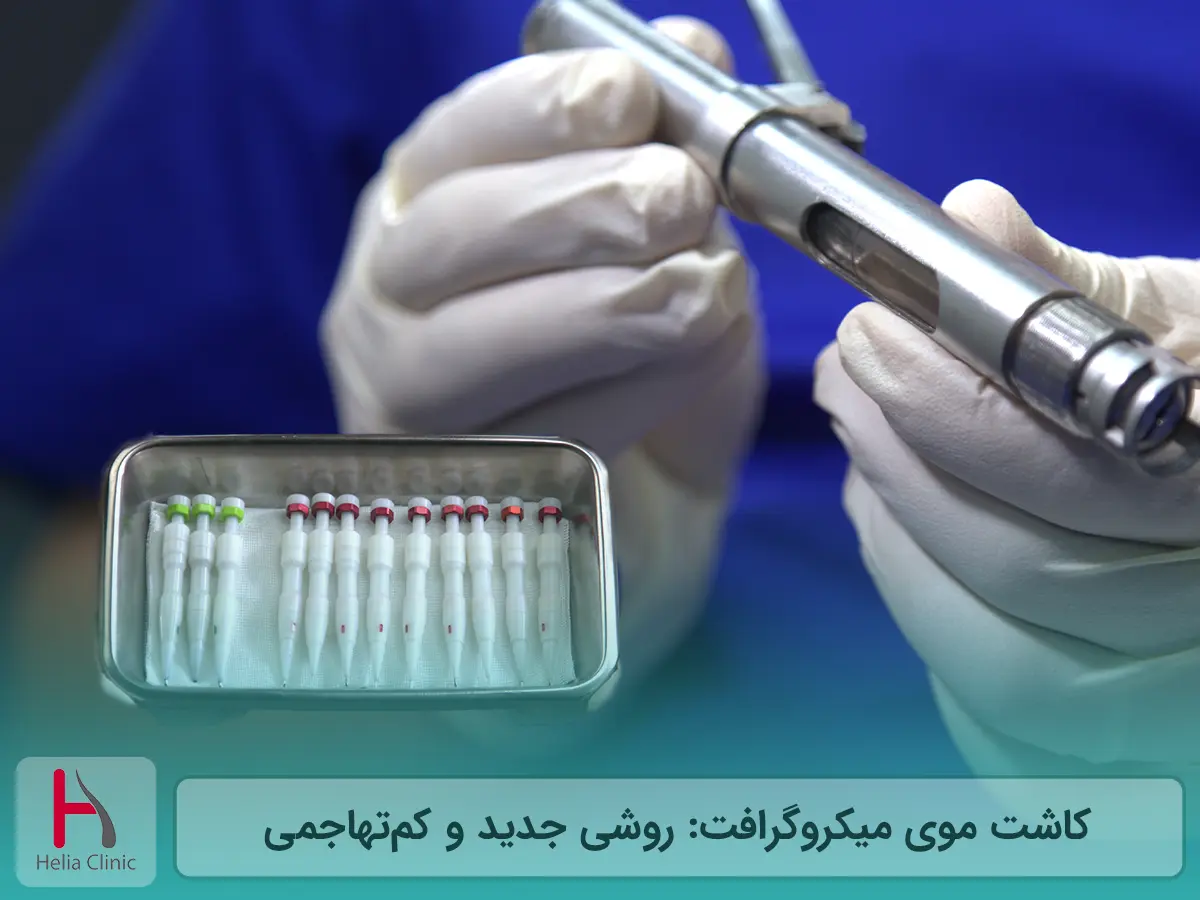 کاشت موی میکروگرافت: روشی جدید و کم‌تهاجم