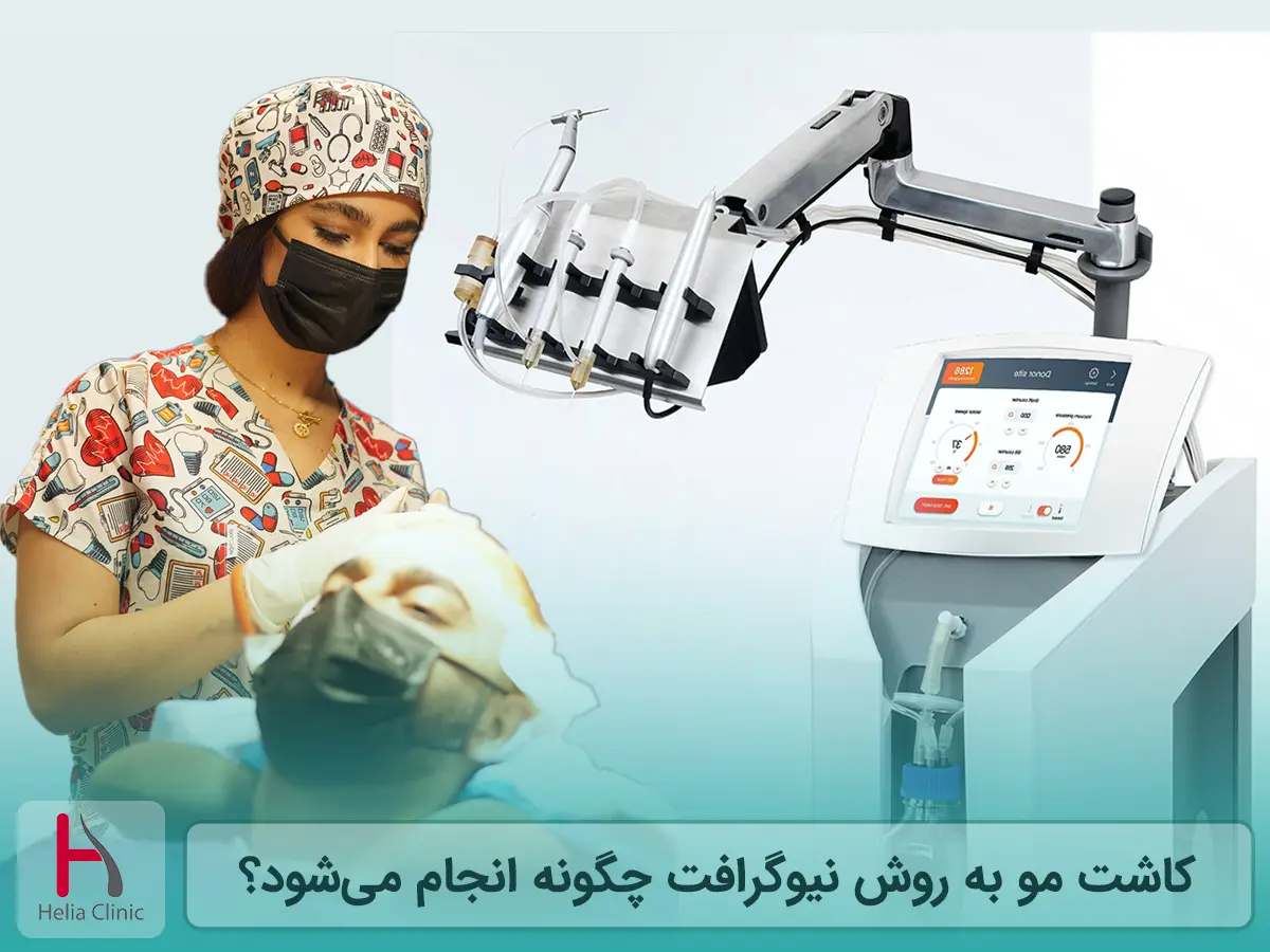 کاشت مو به روش نیوگرافت چگونه انجام میشود؟