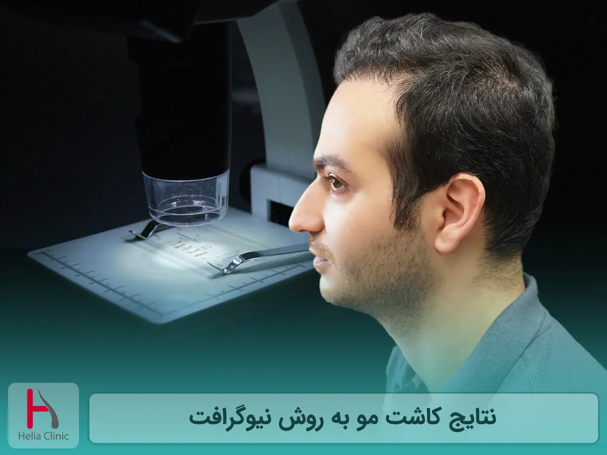 نتایج کاشت مو به روش نیوگرافت