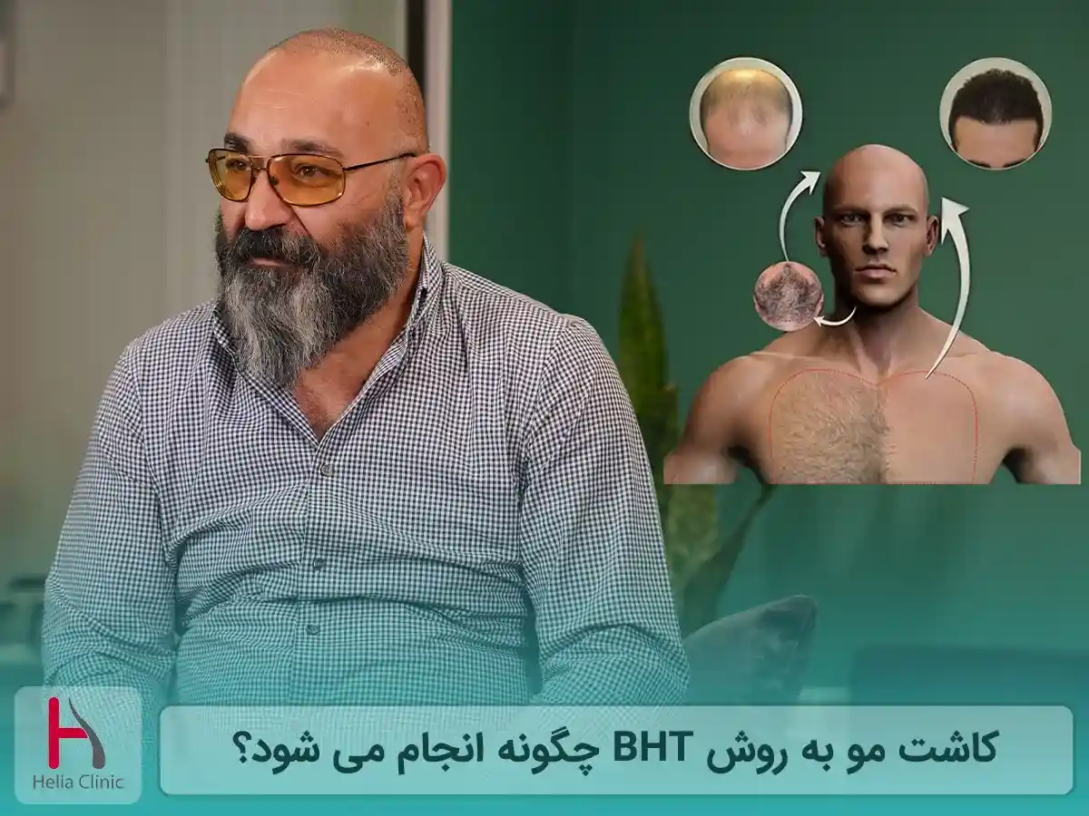 کاشت مو به روش BHT چگونه انجام می شود؟