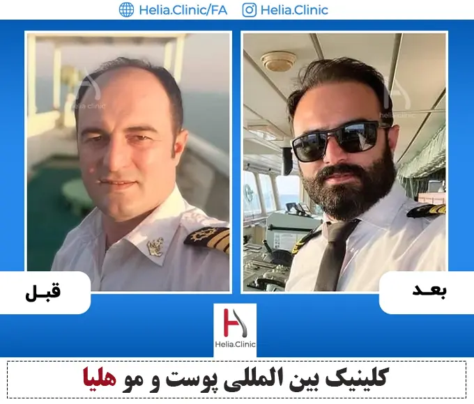 عکس کاشت مو به روش fit