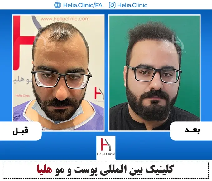 عکس کاشت مو به روش میکروگرافت