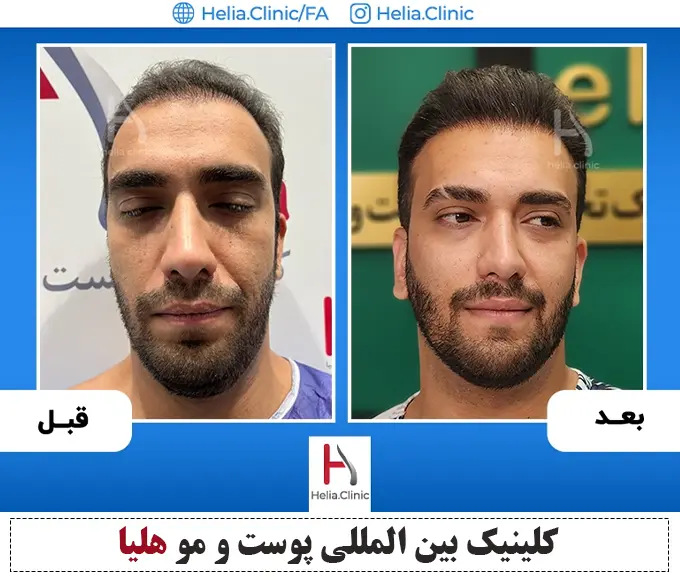 عکس کاشت مو به روش sut