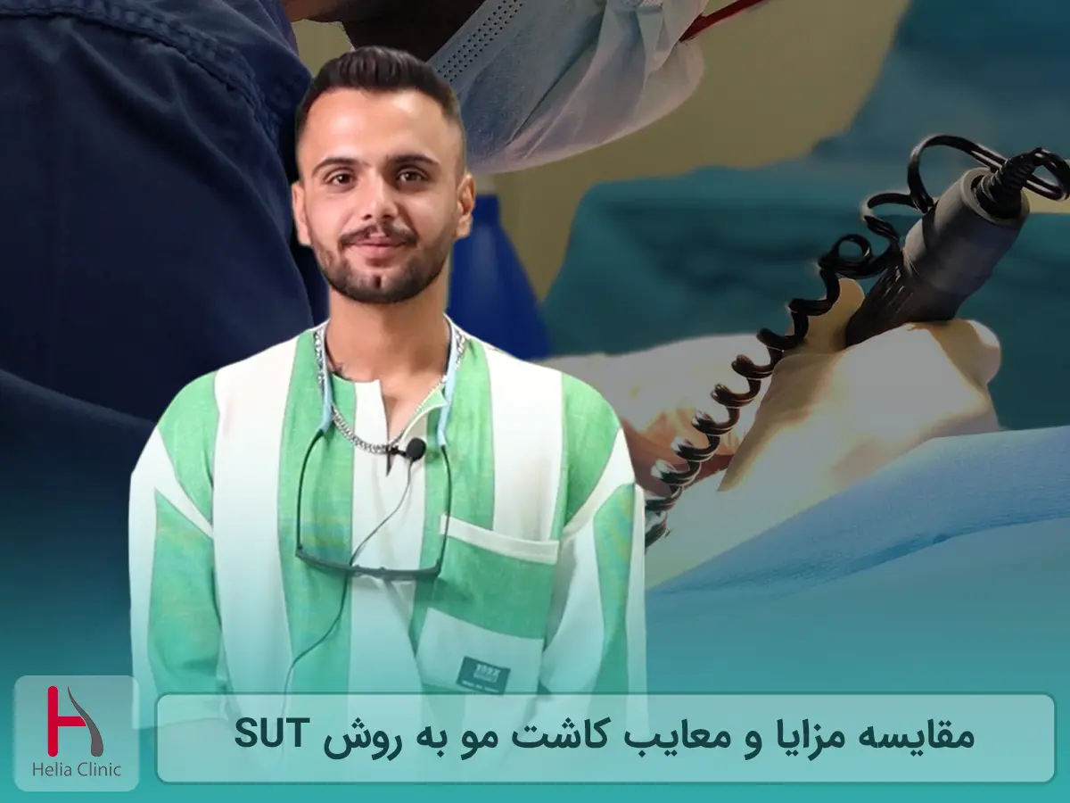 مقایسه مزایا و معایب کاشت مو به روش SUT