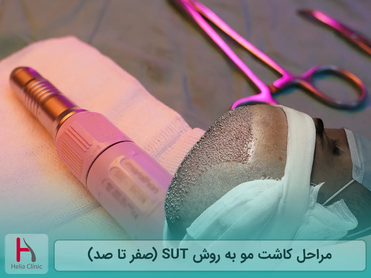 مراحل کاشت مو به روش SUT (صفر تا صد)