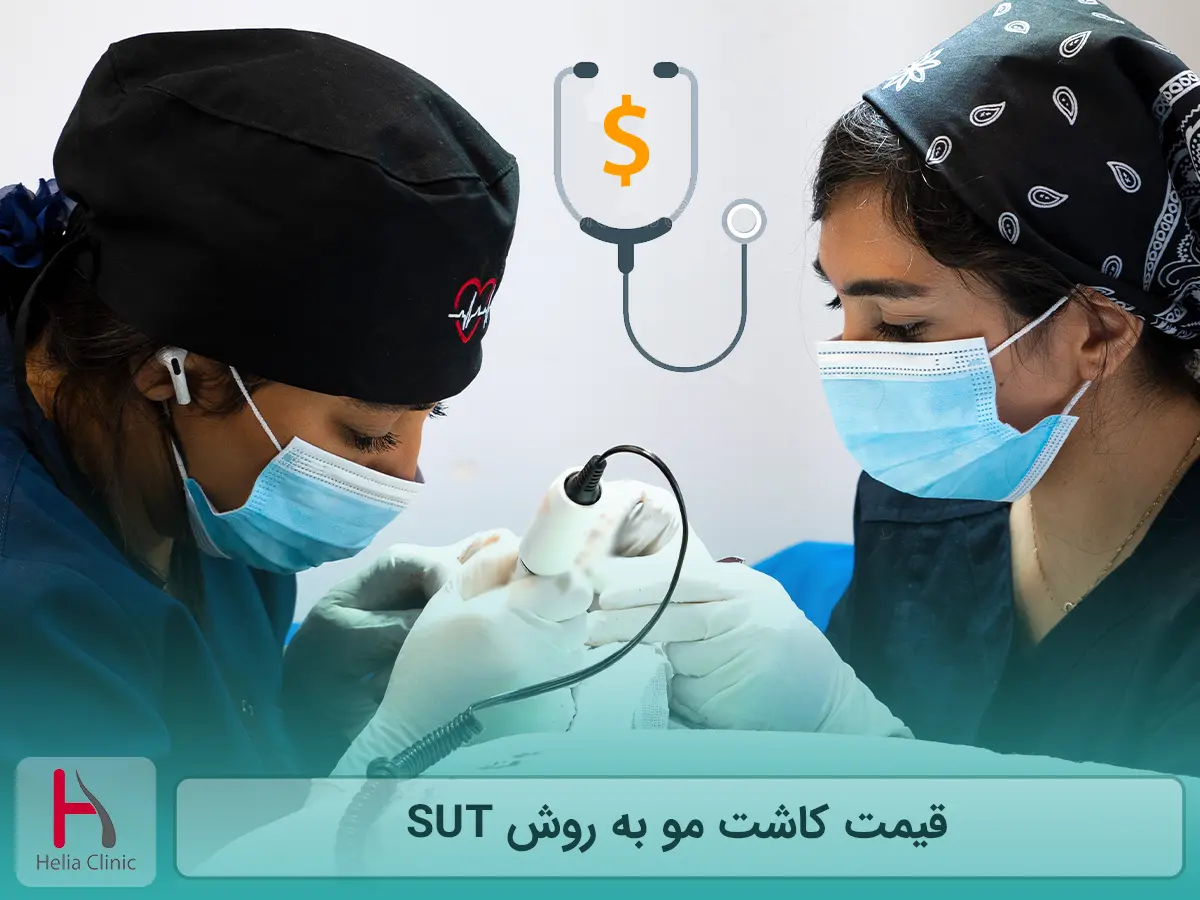 قیمت کاشت مو به روش SUT