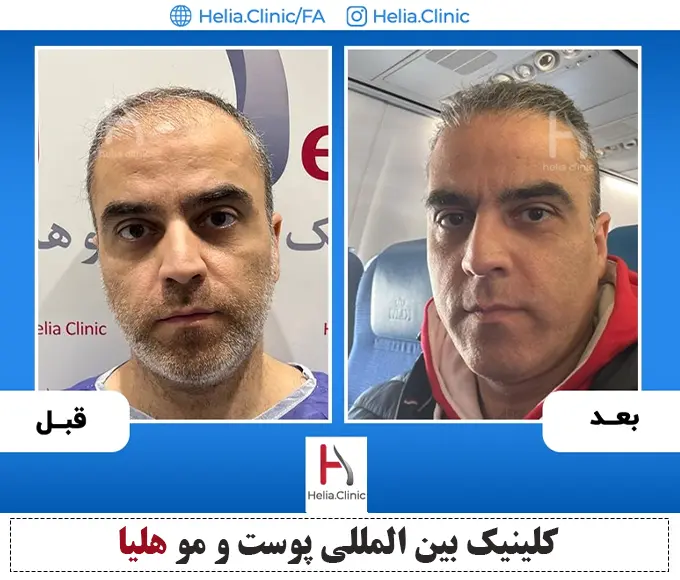 نمونه قبل وبعد پیوند مو میکروگرافت