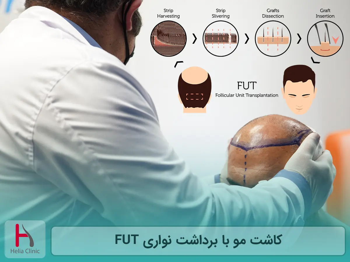 کاشت مو با برداشت نواری FUT