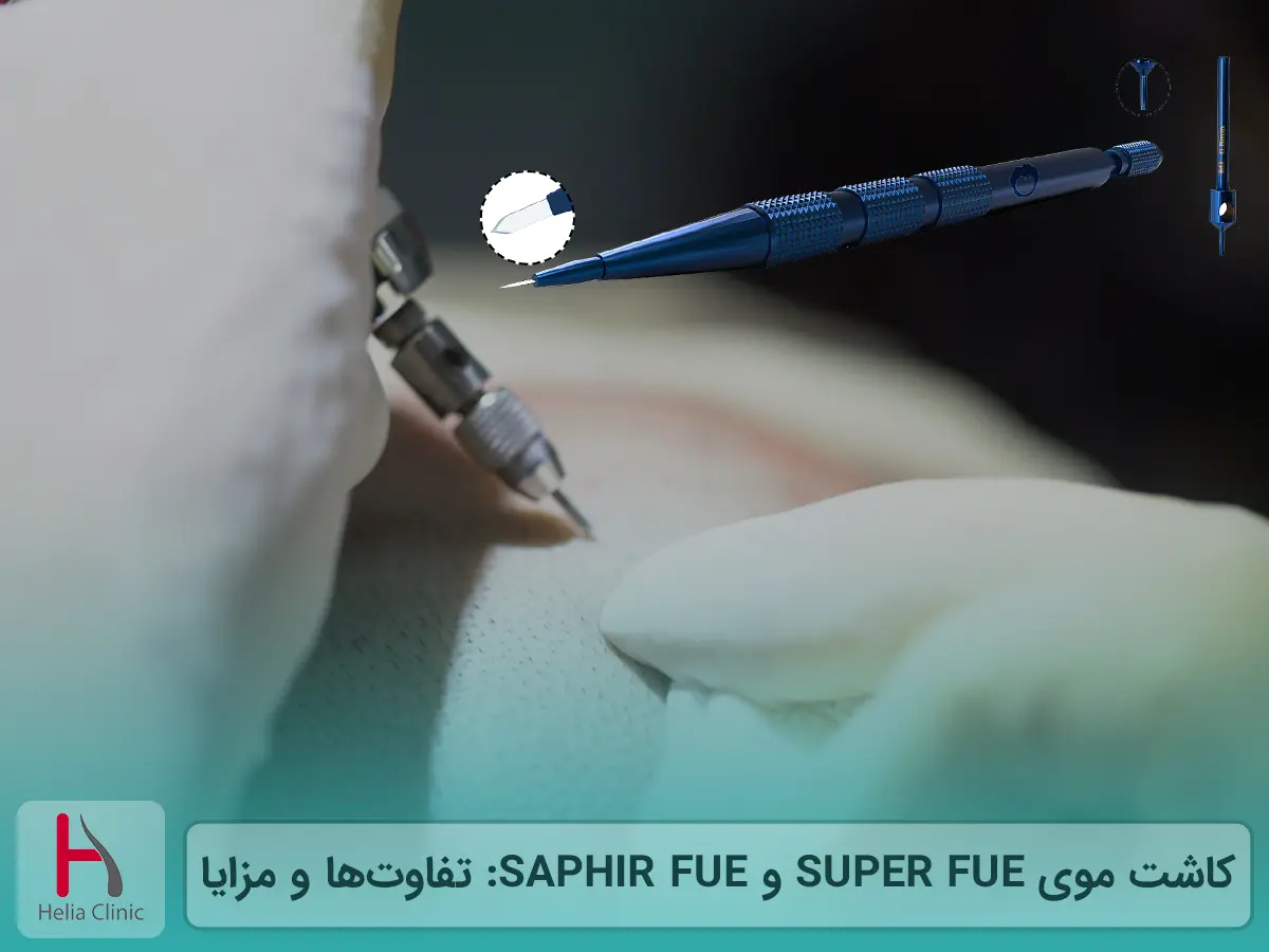 کاشت موی SUPER FUE و SAPHIR FUE: تفاوت‌ها و مزایا