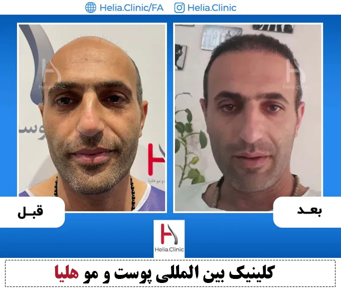 تجربه پیوند مو به شیوه اس یو تی در تهران