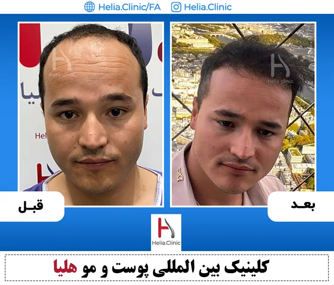 انواع روش پیوند مو در کلینیک هلیا