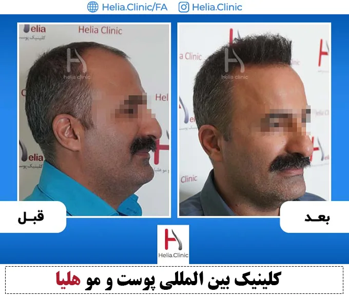 نتیجه پیوند مو به روش دی اچ آی