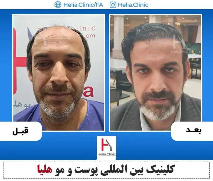 نتیجه کاشت مو به روش اف آی تی در کلینیک هلیا