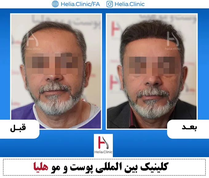 نتیجه پیوند مو با شیوه میکروگرافت